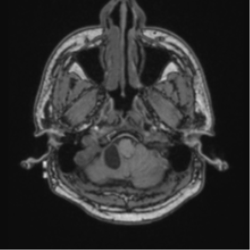 Cerebellar hemangioblastomas and pituitary adenoma (Radiopaedia 85490-101176 Axial T1 9).png