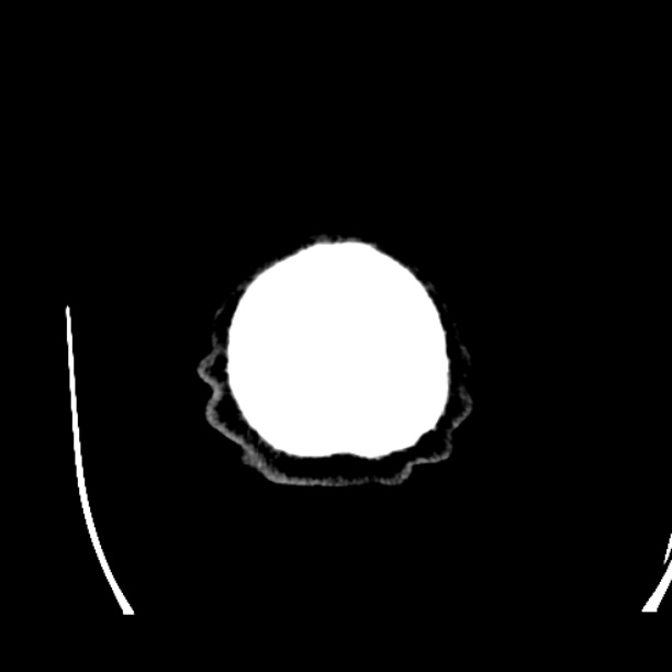 Cerebellar hemorrhage (Radiopaedia 27193-27359 Axial non-contrast 56).jpg