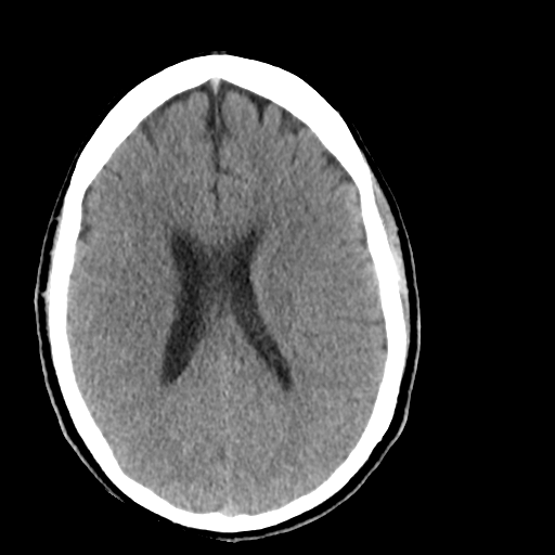 File:Cerebellar infarct due to vertebral artery dissection with posterior fossa decompression (Radiopaedia 82779-97029 Axial non-contrast 17).png