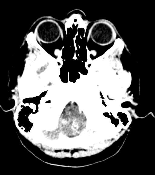 Cerebellar metastases - colorectal adenocarcinoma (Radiopaedia 40947-43652 Axial C+ 6).png