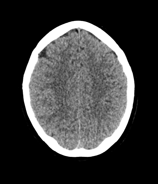 Cerebellar metastases - colorectal adenocarcinoma (Radiopaedia 40947-43652 Axial non-contrast 47).png