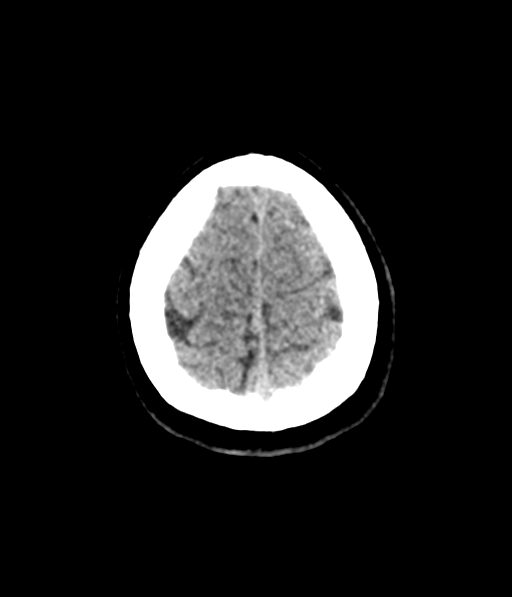 Cerebellar metastases - colorectal adenocarcinoma (Radiopaedia 40947-43652 Axial non-contrast 61).png