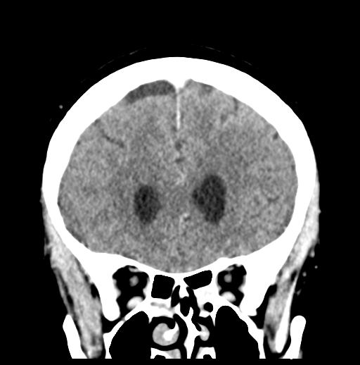 Cerebellar metastasis (Radiopaedia 54578-60812 Coronal C+ 17).png