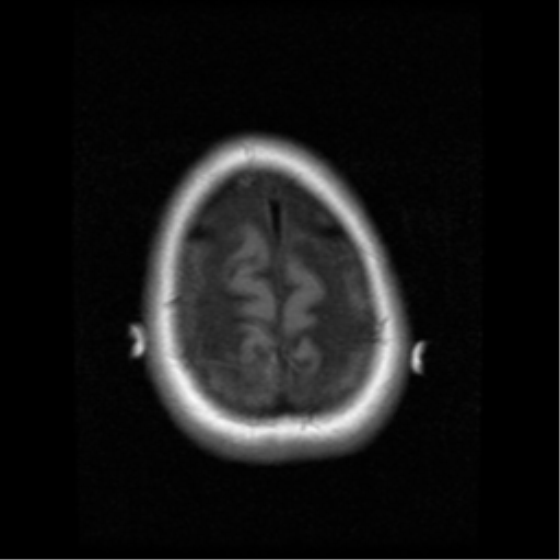 File:Cerebellar metastasis (cystic appearance) (Radiopaedia 41395-44262 Axial T1 21).png