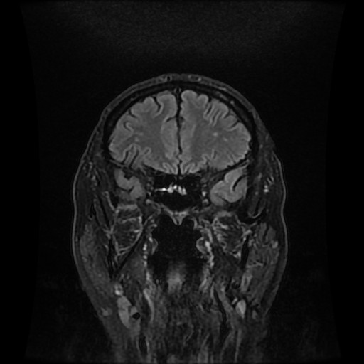 File:Cerebellar metastasis of pulmonary adenocarcinoma, cavernous venous malformation, and developmental venous anomaly (Radiopaedia 85827-101661 Coronal FLAIR 11).jpg