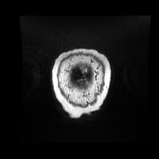 Cerebellar metastasis of pulmonary adenocarcinoma, cavernous venous malformation, and developmental venous anomaly (Radiopaedia 85827-101661 Coronal T1 C+ 9).jpg