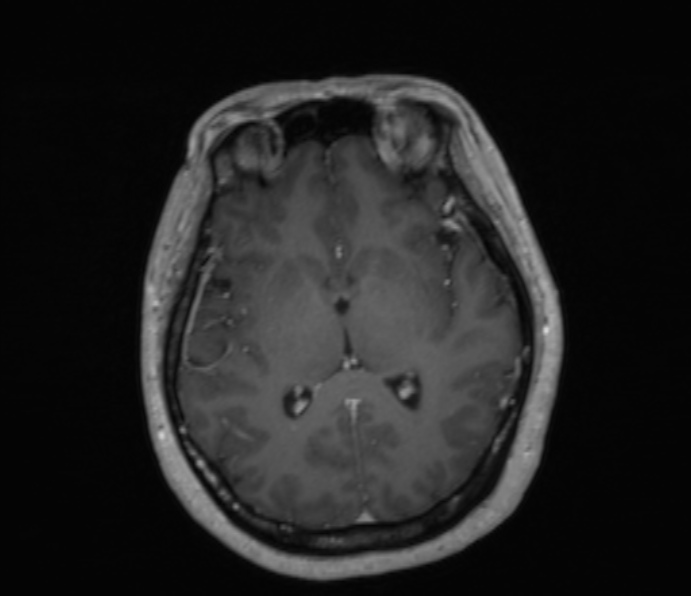 Cerebellopontine angle meningioma (Radiopaedia 35181-36715 Axial T1 C+ 28).jpg