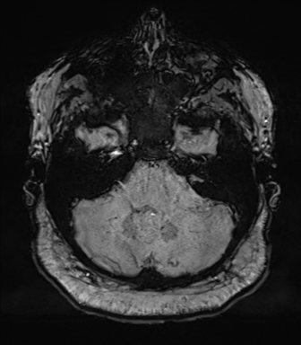 Cerebellopontine angle meningioma (Radiopaedia 48434-53348 Axial SWI 21).png