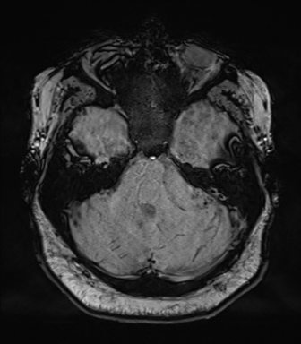 File:Cerebellopontine angle meningioma (Radiopaedia 48434-53348 Axial SWI 26).png