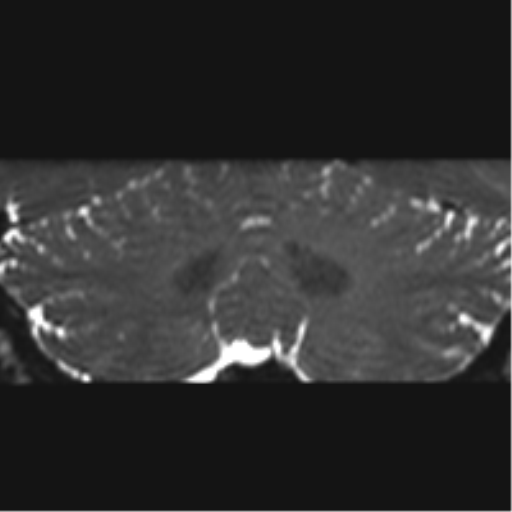 Cerebellopontine angle meningioma (Radiopaedia 48434-53348 Coronal T2 13).png