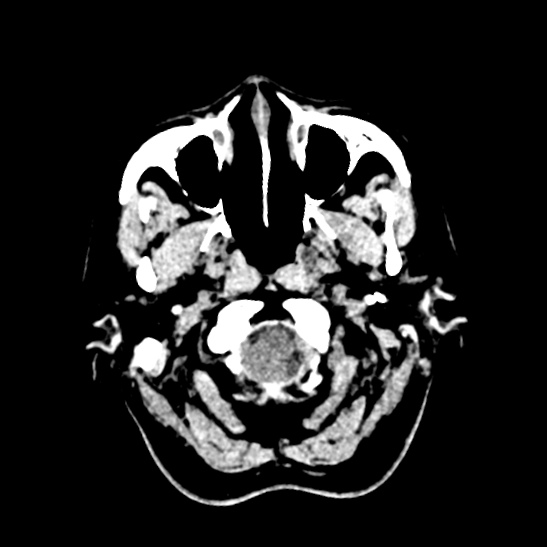 Cerebellopontine angle meningioma (Radiopaedia 53561-59592 Axial non-contrast 5).jpg