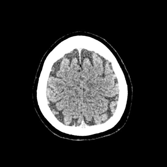 Cerebellopontine angle meningioma (Radiopaedia 53561-59592 Axial non-contrast 58).jpg