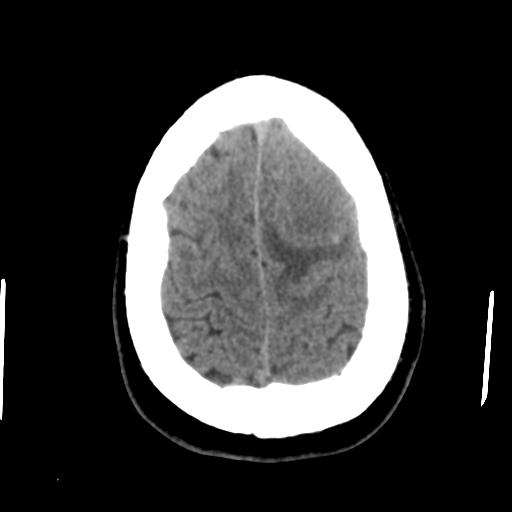 Cerebral abscess (Radiopaedia 29451-29919 Axial non-contrast 43).jpg