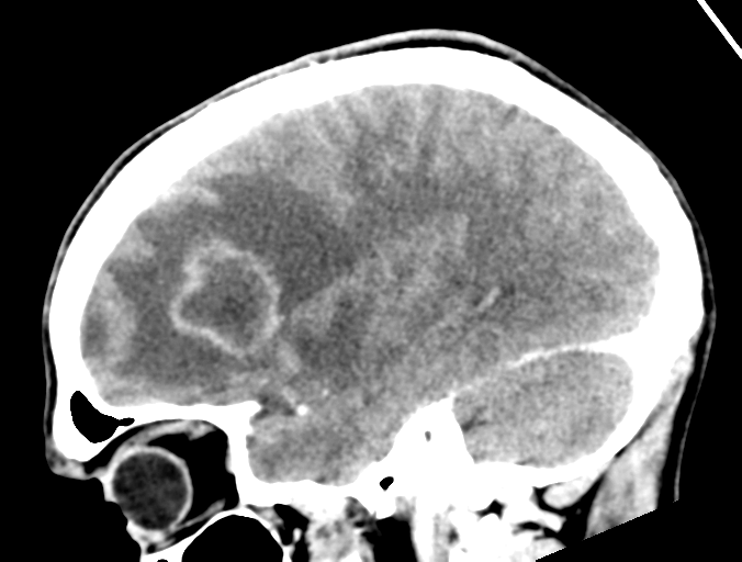 Cerebral abscess (Radiopaedia 60342-68008 Sagittal C+ delayed 36).png