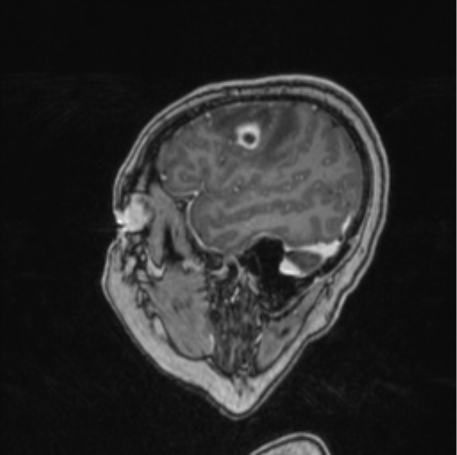 Cerebral abscess from pulmonary arteriovenous malformation (Radiopaedia 86275-102291 Sagittal T1 C+ 63).png