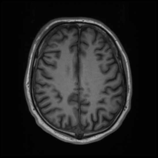 File:Cerebral abscess with ventriculitis (Radiopaedia 78965-91878 Axial T1 34).jpg