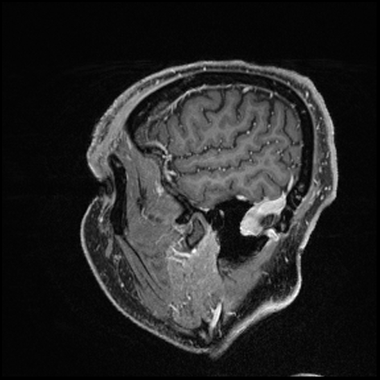 Cerebral abscess with ventriculitis (Radiopaedia 78965-91878 Sagittal T1 C+ 33).jpg