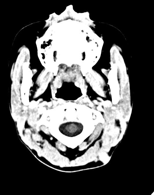 Cerebral abscesses (Radiopaedia 70458-80568 Axial Contrast 6).jpg