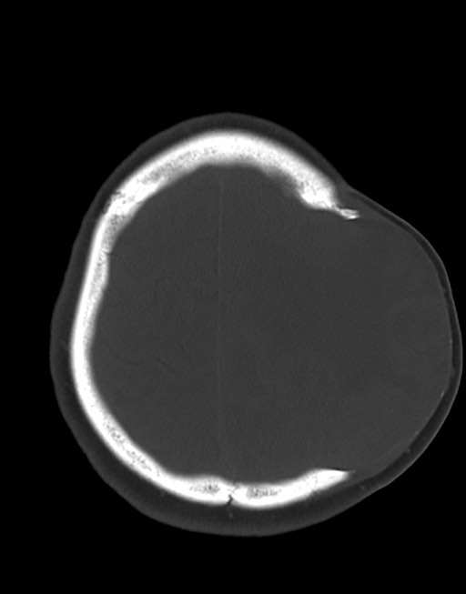 Cerebral abscesses (Radiopaedia 70458-80568 Axial bone window 49).jpg