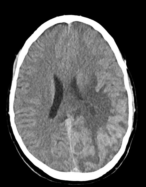 Cerebral abscesses (Radiopaedia 70458-80568 Axial non-contrast 38).jpg