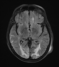 File:Cerebral amyloid angiopathy-related inflammation (Radiopaedia 74836-85849 Axial FLAIR 15).jpg