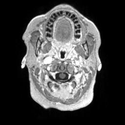 Cerebral amyloid angiopathy (Radiopaedia 29129-29518 Axial T1 C+ 8).jpg