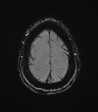 Cerebral amyloid angiopathy (Radiopaedia 46082-50433 Axial SWI 77).png
