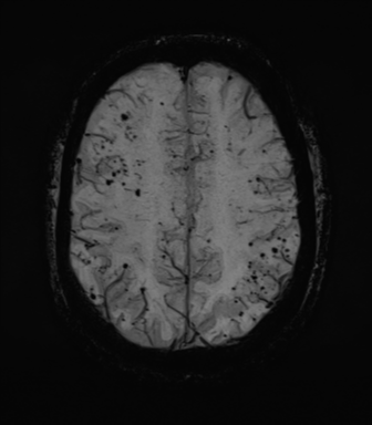 Cerebral amyloid angiopathy (Radiopaedia 46082-50433 Axial SWI MIP 57).png