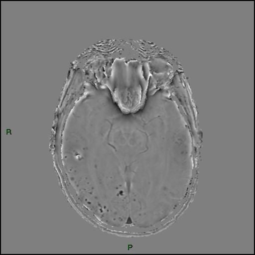 Cerebral amyloid angiopathy (Radiopaedia 77506-89664 H 46).jpg