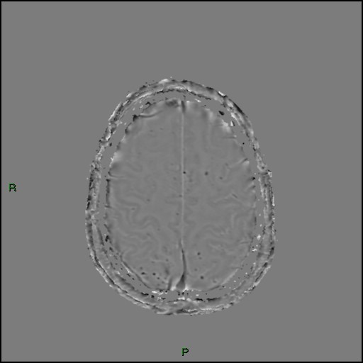 Cerebral amyloid angiopathy (Radiopaedia 77506-89664 H 83).jpg