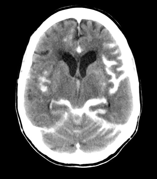 File:Cerebral aneurysm with rupture (Radiopaedia 29933-30460 Axial non-contrast 12).jpg
