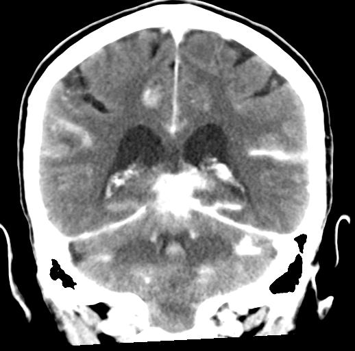 File:Cerebral aneurysm with rupture (Radiopaedia 29933-30460 Coronal non-contrast 24).jpg