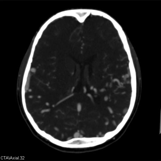 Cerebral arteriovenous malformation (Radiopaedia 28518-28759 B 32).jpg