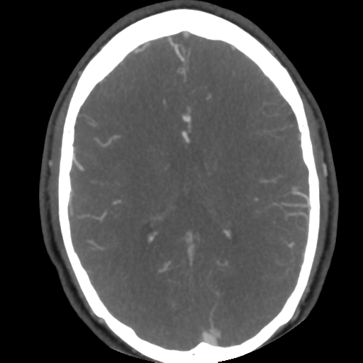 Cerebral arteriovenous malformation (Radiopaedia 39259-41505 AX CEREBRAL CTA 34).png