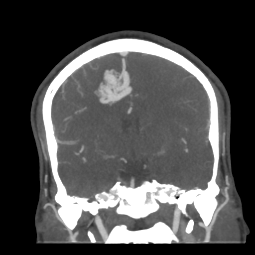 File:Cerebral arteriovenous malformation (Radiopaedia 39259-41505 E 32).png