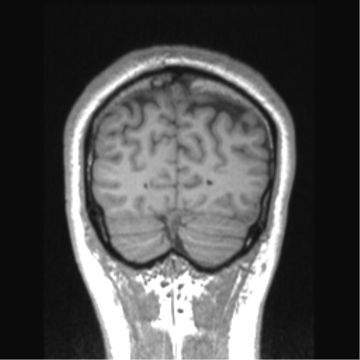 Cerebral arteriovenous malformation (Radiopaedia 39259-41506 Coronal T1 17).png