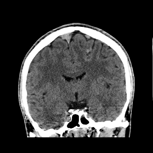 Cerebral arteriovenous malformation (Radiopaedia 61964-70028 Coronal non-contrast 29).jpg