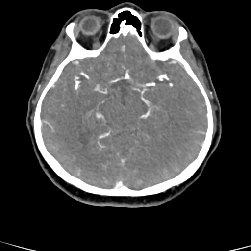 Cerebral arteriovenous malformation (Radiopaedia 73830-84645 B 58).jpg