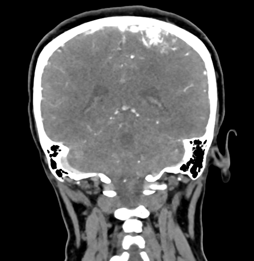 Cerebral arteriovenous malformation (Radiopaedia 73830-84645 C 67).jpg