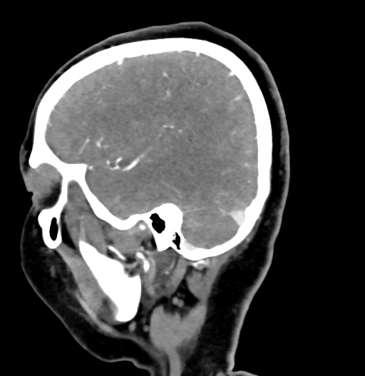 Cerebral arteriovenous malformation (Radiopaedia 73830-84645 D 22).jpg