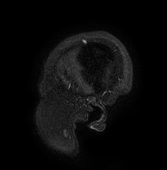 Cerebral arteriovenous malformation (Radiopaedia 74411-85654 Sagittal FLAIR 1).jpg