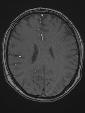 Cerebral arteriovenous malformation (Radiopaedia 84015-99245 Axial TOF 150).jpg