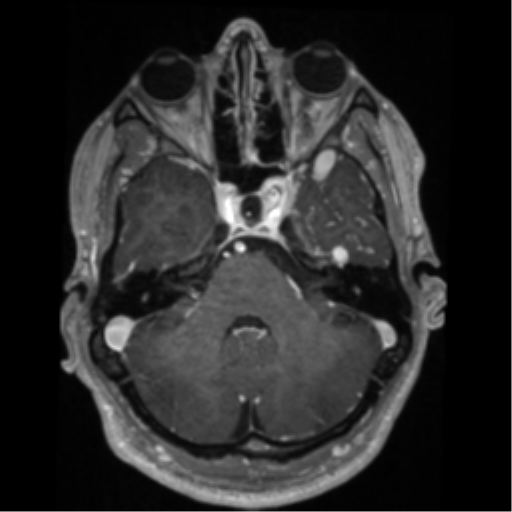 Cerebral arteriovenous malformation - huge (Radiopaedia 35734-37272 Axial T1 C+ 17).png
