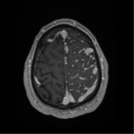 Cerebral arteriovenous malformation - huge (Radiopaedia 35734-37272 Axial T1 C+ 63).png