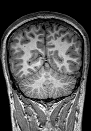 Cerebral arteriovenous malformation at posterior body of corpus callosum (Radiopaedia 74111-84925 Coronal T1 261).jpg