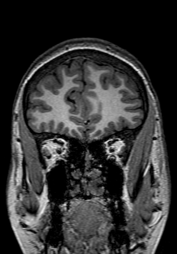 Cerebral arteriovenous malformation at posterior body of corpus callosum (Radiopaedia 74111-84925 Coronal T1 50).jpg