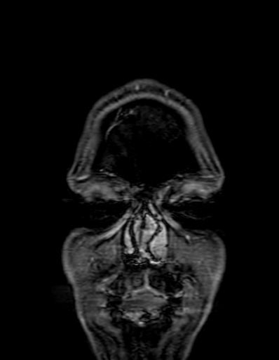 Cerebral arteriovenous malformation at posterior body of corpus callosum (Radiopaedia 74111-84925 K 1).jpg