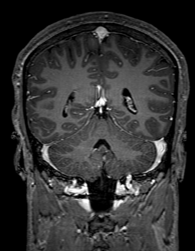 Cerebral arteriovenous malformation at posterior body of corpus callosum (Radiopaedia 74111-84925 K 255).jpg