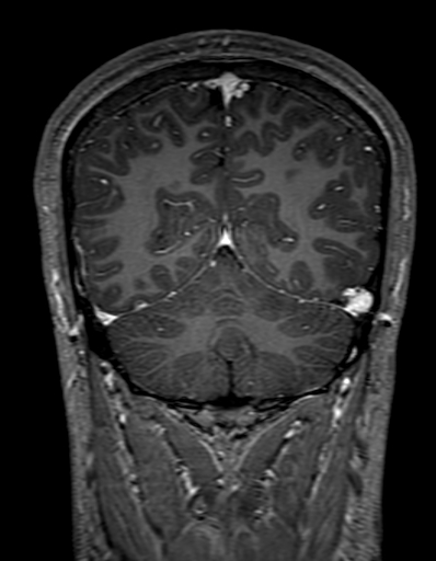 Cerebral arteriovenous malformation at posterior body of corpus callosum (Radiopaedia 74111-84925 K 286).jpg