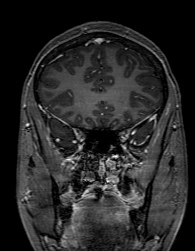 Cerebral arteriovenous malformation at posterior body of corpus callosum (Radiopaedia 74111-84925 K 97).jpg